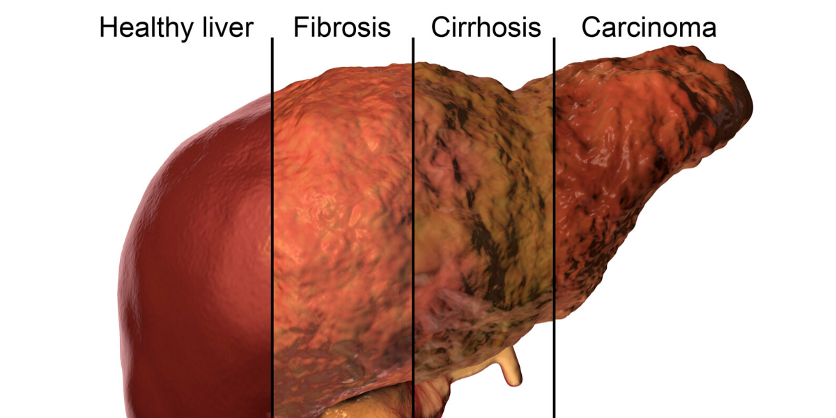 liver failure from supplements