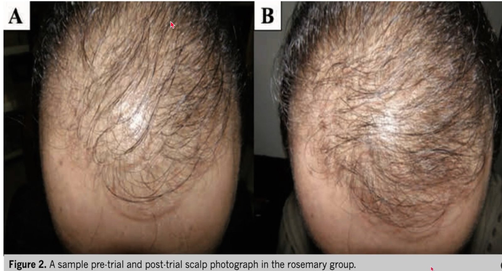 Rosemary oil hair growth before after